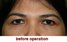 plastic-surgery-blepharoplasty